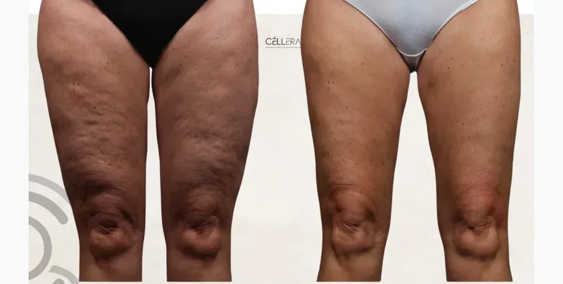 Tratamiento Celulitis