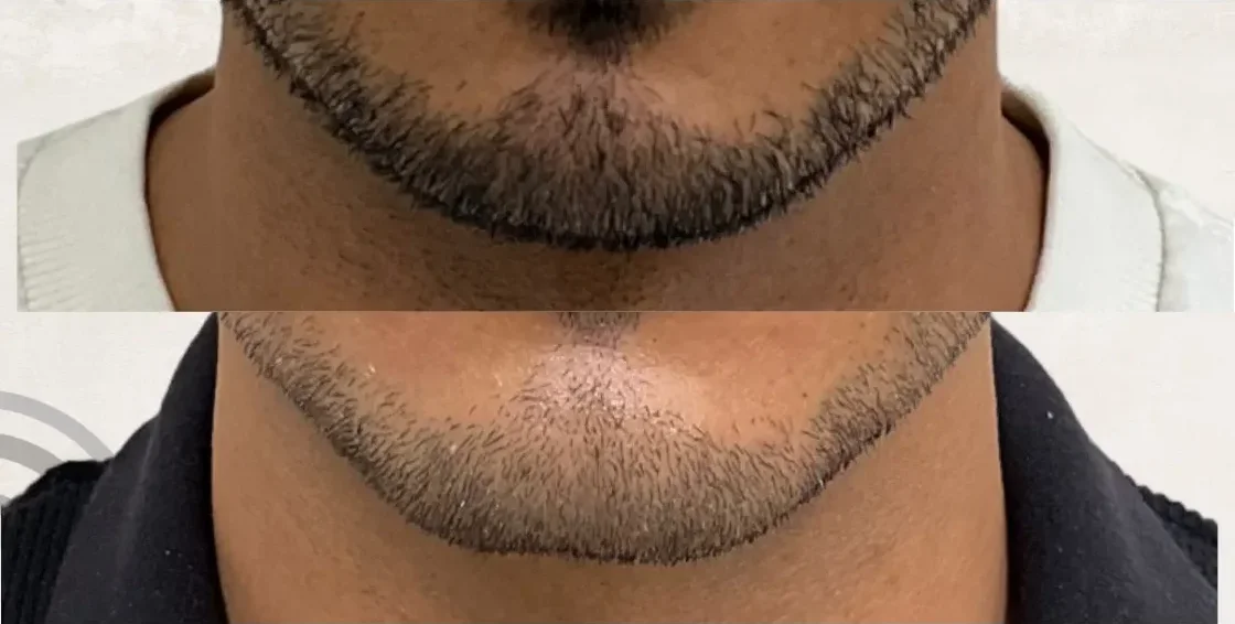 Chin Filler